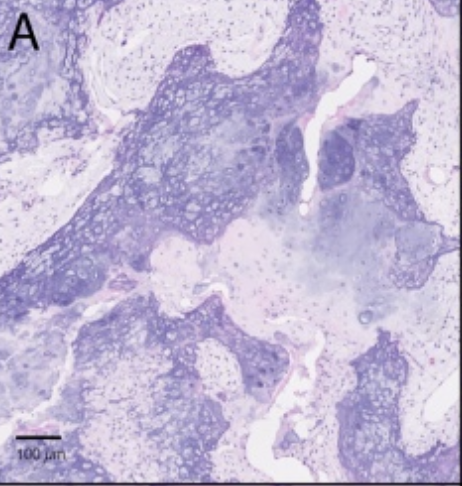 <p>1) bizare parosteal osteochondromatous proliferation (BPOB)</p><p>2) </p><ul><li><p>apposé sur l’os cortical </p></li></ul><p>3) </p><ul><li><p>cartilage atypique hypercellulaire mais sans mitose atypique</p></li><li><p>Os avec ossification enchondrale</p></li><li><p>Stroma fusocellulaire non atypique hypervasculaire (Blue bone, voir photo) </p></li><li><p>Pas de continuité médullaire ! </p></li></ul><p>4) </p><p>t(11;17) </p>