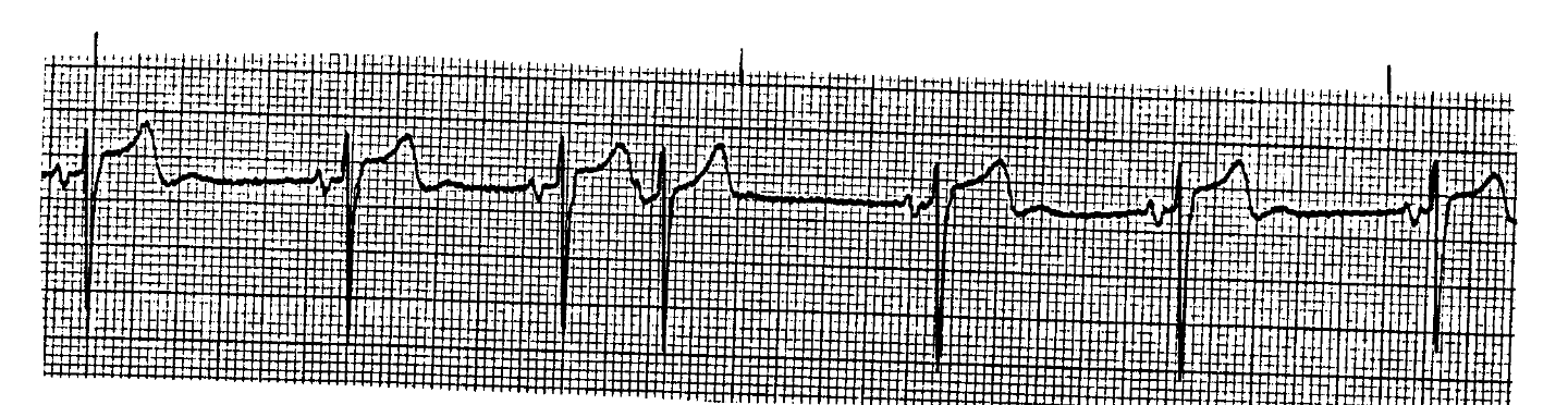 <p>What ECG is this? </p>