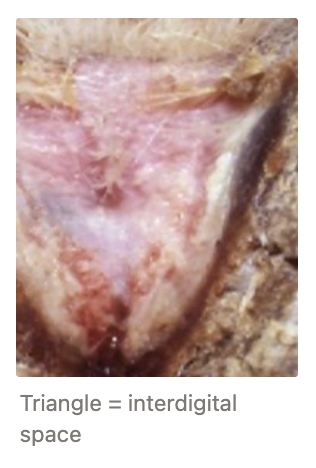 <p><u>Clinical Signs:</u> MAY resolve spontaneously in dry conditions</p><ol><li><p>Superficial and mild infection = Erythema and moisture of interdigital space</p></li><li><p>Mild - moderate lameness</p></li></ol><p><strong>Necessary precursor for foot abscess/footrot</strong></p><p><u>Treatment:</u> Topical antibiotics (blue spray = oxytetracycline) OR footbath</p><ul><li><p>Ideally place in drier environment BUT typically indoors → Reduced grazing</p></li><li><p>Ideally multiple treatments of blue spray but not feasible on large farm</p></li></ul><p></p>