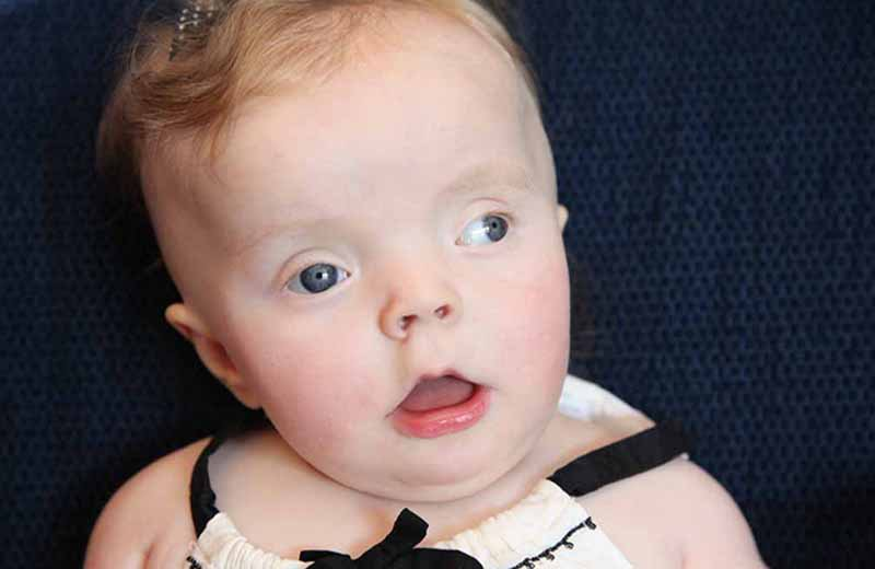<p><span>This is a newborn infant with a mosaic form of Pallister-Killian syndrome. What are two dysmorphic features that you recognize?</span></p>