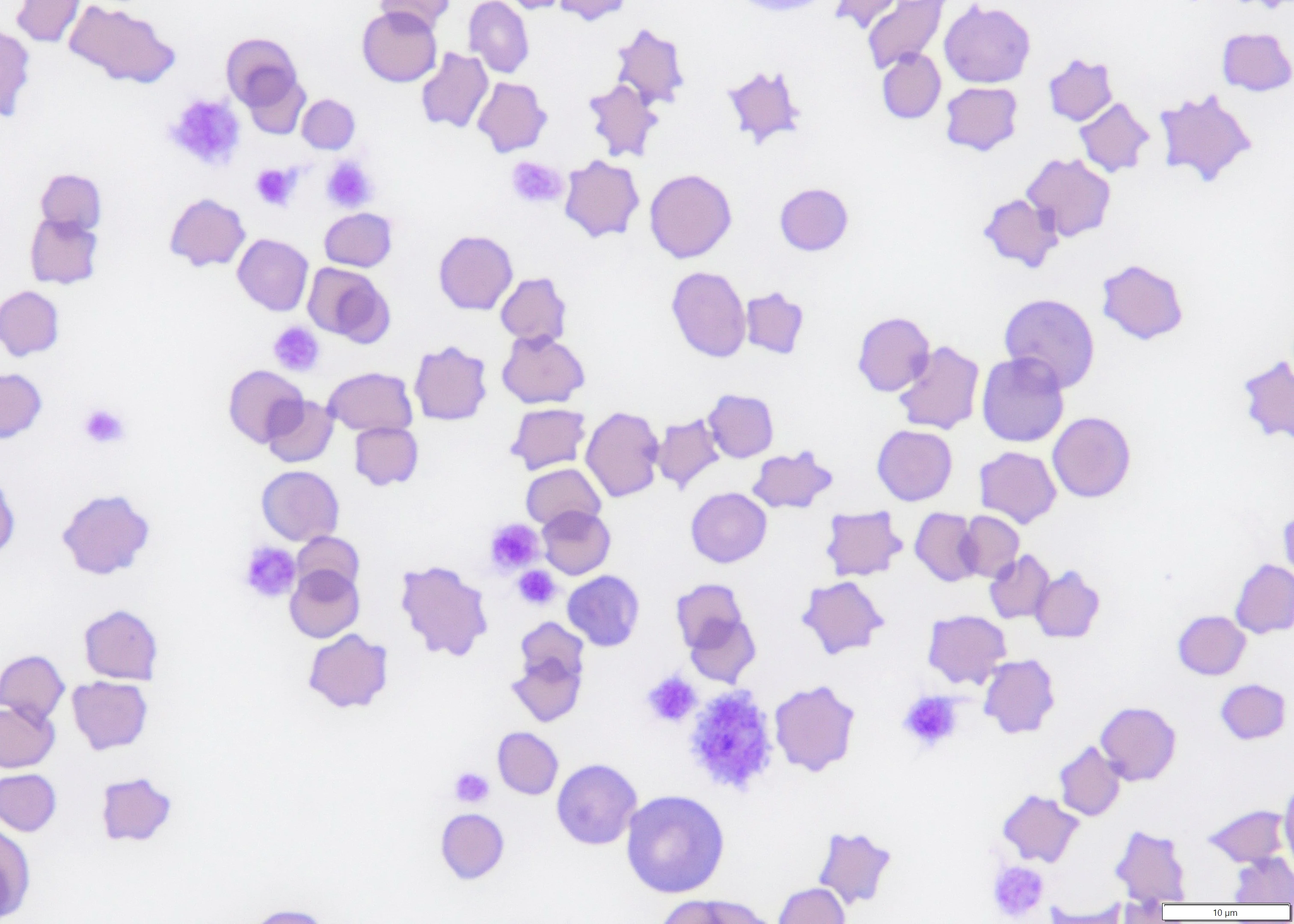 <p>THROMBOCYTOSIS</p>