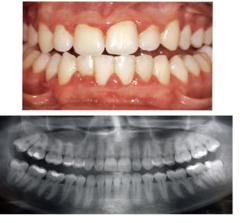 <p>Gingivitis or periodontitis?</p>