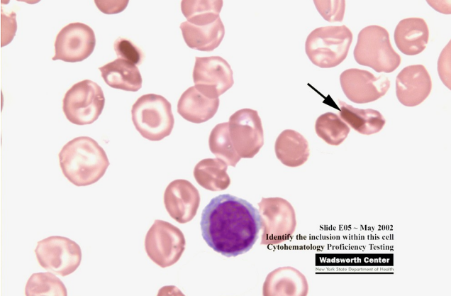 <p>what would the RBC morphology look like in those with HbC? <strong>(learning objective)</strong></p>