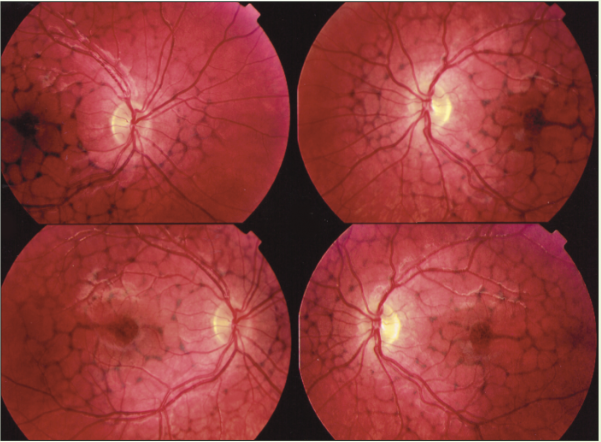 <p>net like pigmentation</p><p>most symmetric of all types</p><p>ERG: normal/mild decrease</p><p>EOG: normal/mild decrease </p>
