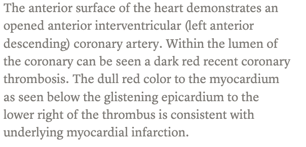 <p>dark red recent coronary thrombosis </p>