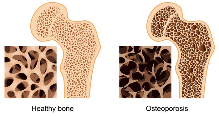 <p>Porous bone condition</p><p>Bone resorption (breakdown) out does bone deposition (formation)</p><p>Mostly caused by calcium depletion in the body</p>