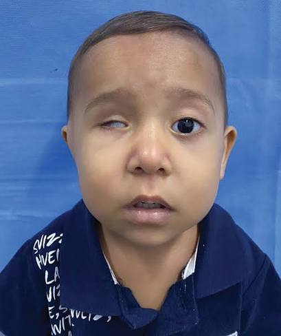 <p>Afección congénita y rara donde uno o ambos ojos no se desarrollan por completo, resultando en un globo ocular anormalmente pequeño. </p>