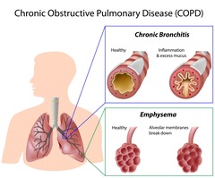 <p>chronic obstructive pulmonary disease</p>