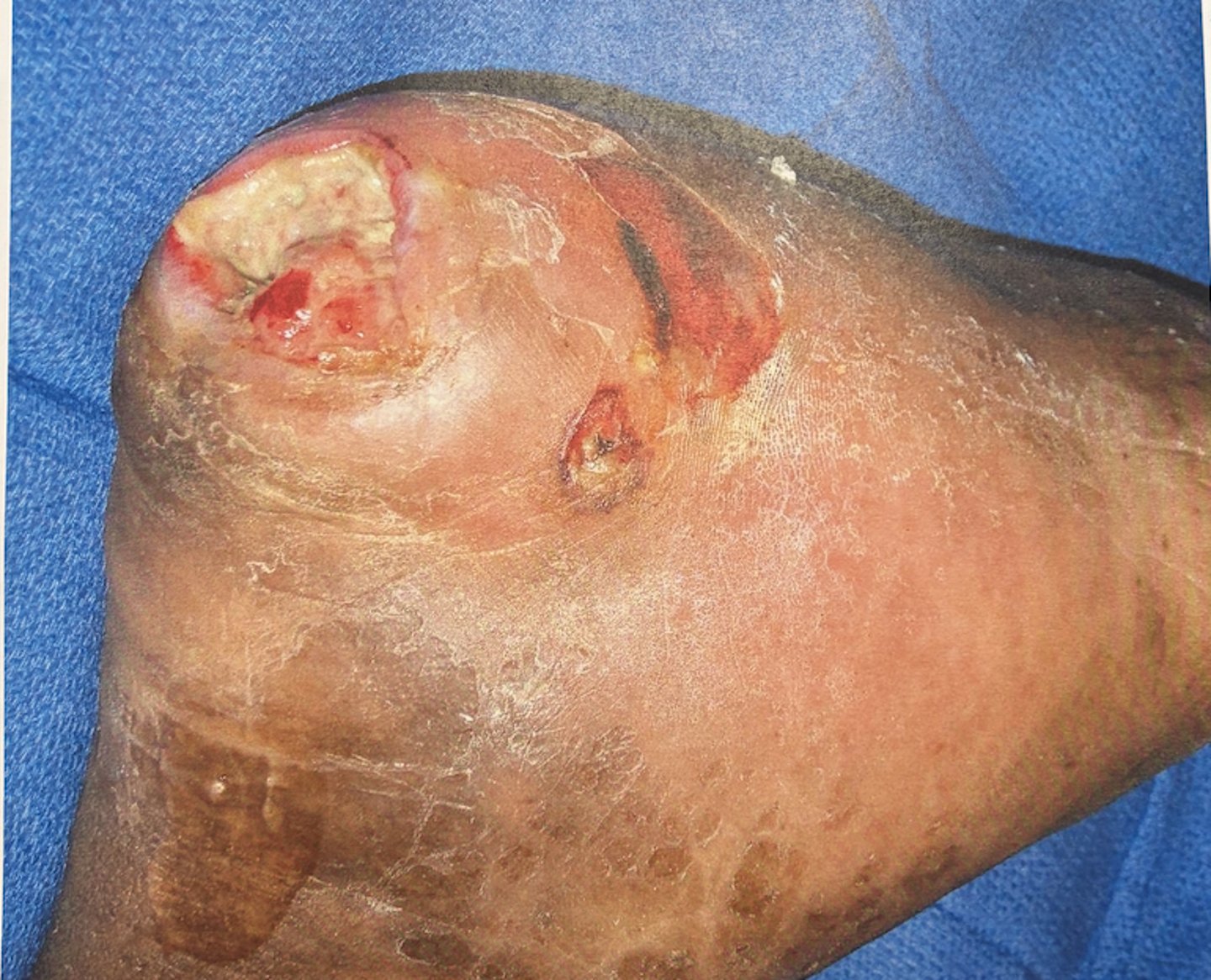 <p>how do you care for this wound?</p>
