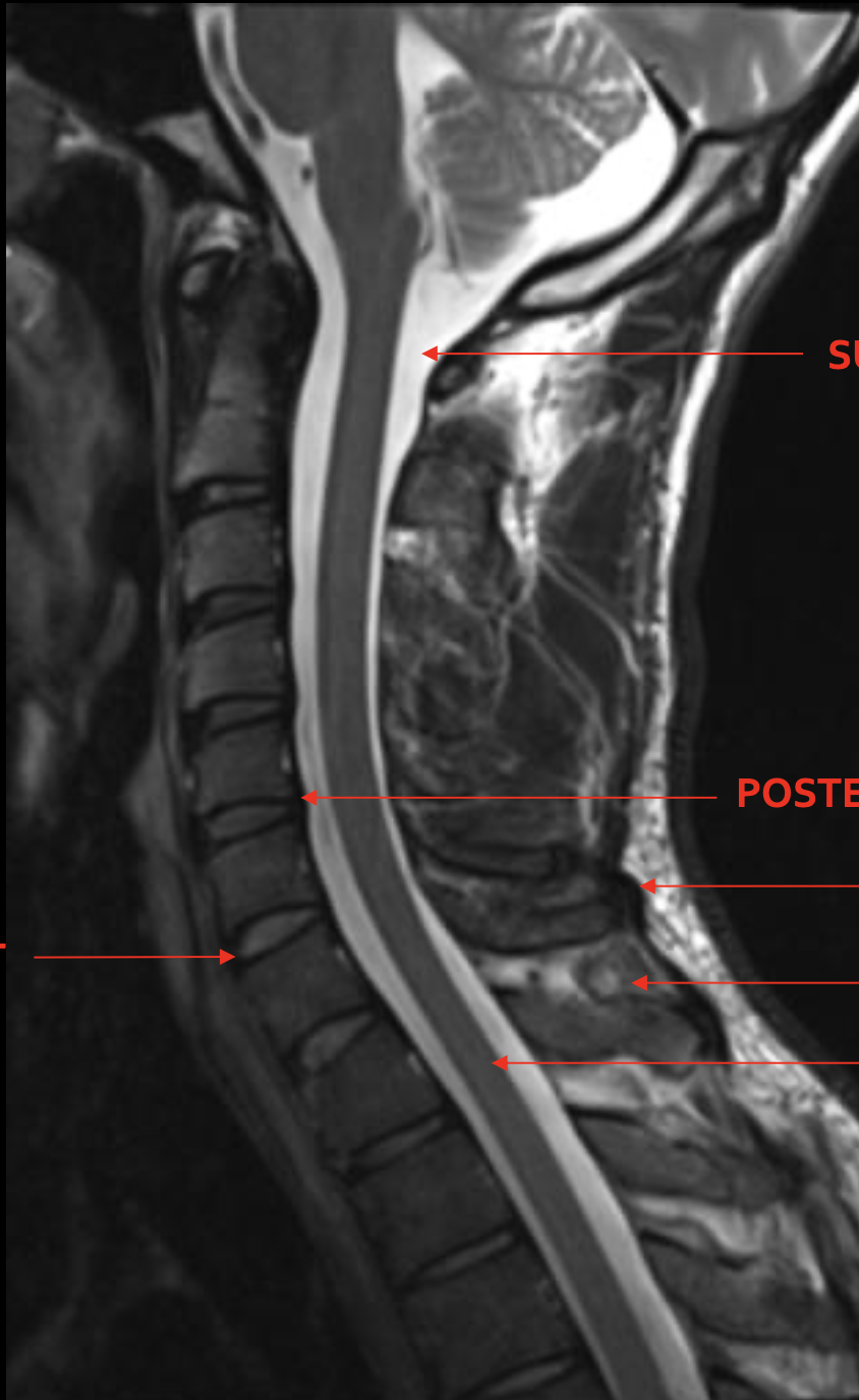 <p><span>蛛网膜下腔</span></p>