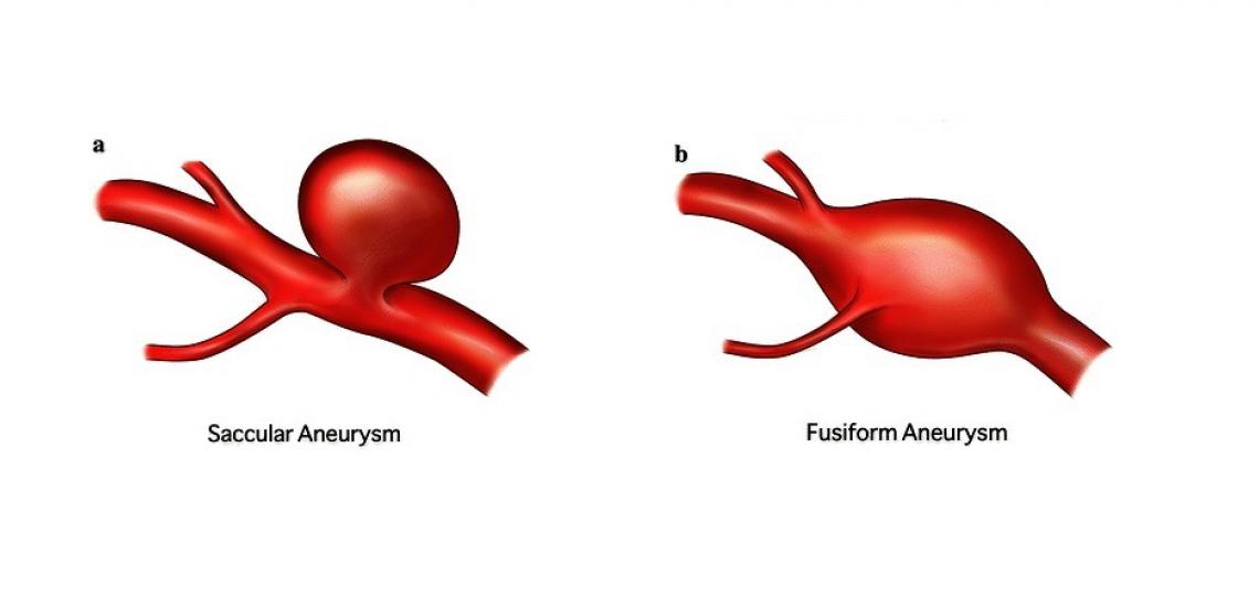 <p>Saccular: Shows sudden transition between normal and abnormal. Somewhat spherical and longer</p><p>Fusiform: Gradual transition between normal and abnormal. “Football-like” shape</p>