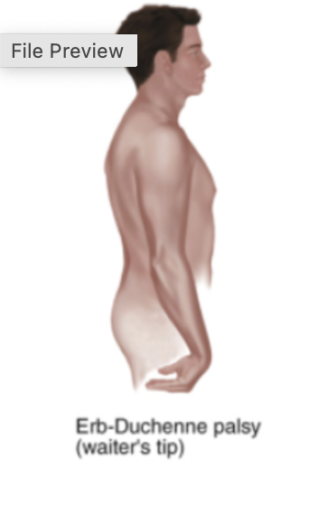 <p><strong>Erb-Duchenne Palsy</strong></p>