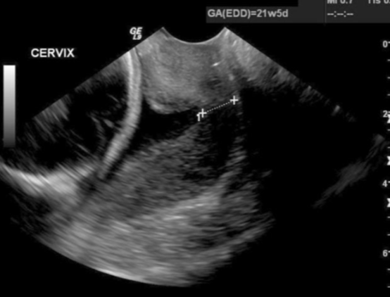 <ul><li><p>premature opening or shortening of the cervix that may lead to fetal loss</p></li><li><p>may “funnel” (dilation of the internal os)</p><ul><li><p>sign of cervical incompetence</p></li><li><p>dilation of the internal part of the cervical canal and reduction of the cervical length</p></li><li><p>>50% funneling before 25 weeks is associated w/ approx. 80% risk of preterm delivery</p><ul><li><p>measure:</p><ul><li><p><strong>% funneling</strong> → funnel length(functional cervical length + funnel length)</p></li><li><p><strong>depth and width of funnel length</strong></p></li></ul></li><li><p>shape:</p><ul><li><p><strong>U or V shaped funneling</strong></p></li></ul></li></ul></li></ul></li></ul><p></p>