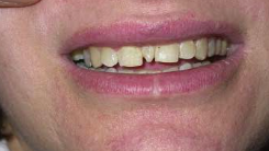 <p>an isolated developmental anomaly</p><p><span style="color: red;">not associated with syndromes &amp; not hereditary</span>, despite occasional increased familial occurrence</p><ul><li><p><strong>location:</strong></p><ul><li><p>located <span style="color: red;">palatal to the permanent incisors</span></p></li></ul></li><li><p>can be positioned to:</p><ul><li><p>erupt normally &amp; be inverted</p></li></ul></li></ul><ul><li><p>clinical findings:</p><ul><li><p>one or two extra teeth may be present</p></li><li><p>frequently <span style="color: red;">conical</span> or have an abnormal morphology</p><p></p></li></ul></li></ul><p></p>
