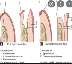 <p>Partial-thickness flap avoids bone exposure, preventing 0.6 mm bone loss.</p><p>(Explanation: Partial-thickness flaps leave the periosteum intact, protecting the bone from exposure and resorption, making them preferable when bone preservation is critical.)</p>