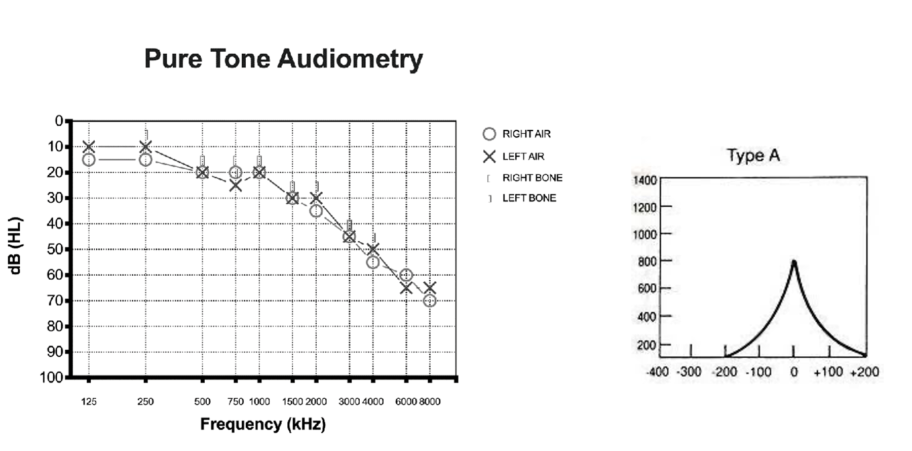 <p><span>Tinnitus (high-pitched)</span></p><p style="text-align: left;"><span>Difficulty hearing in background noise</span></p>