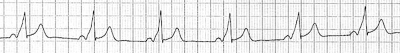 <p>ECG finding in WPW Syndrome</p>