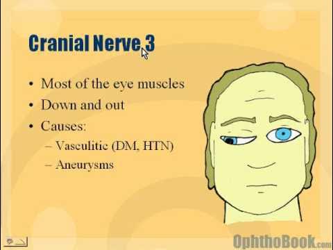 <p><u>CN III (occulomotor nerve)</u></p><p>N: superior rectus<br>inferior rectus<br>medial rectus<br>inferior oblique<br>levator palpebrae (eyelid)<br>iris sphincter (pupil)</p><p><strong>affected eye→down+out</strong></p><p>± pupil dilation</p><p>± ptosis</p>