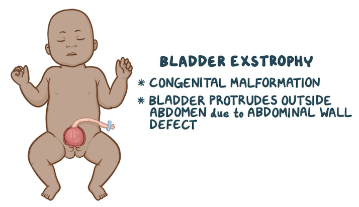 <ul><li><p>defect in lower abdominal wall and anterior wall of urinary bladder</p><ul><li><p>caused by<span style="color: red;"> incomplete closure of inferior part</span> of abdominal wall</p></li><li><p>causes <span style="color: red;">bladder to protrude outside abdomen </span></p></li></ul></li><li><p>defects of the urethra, bladder</p></li><li><p>may be mild or severe (accompanied by omphalocele, inguinal hernia, undescended testes, anal problems)</p></li></ul><p></p>