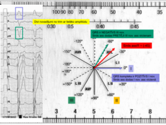 <p>1. nav izoelektrisks</p><p>2. 1. un 3. ar lielāko amplitūdu </p><p>3. pirmais ir pozitīvs - iet tajā pašā virzienā</p><p>4. trešais ir negatīvs- tātad pretējā virzienā</p><p> lielāka voltāža ir trešajā -> tāpēc ass nobīdās tuvāk trešajam novadījumam</p><p>aptuveni -45</p>