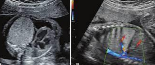 <ul><li><p>Most common, 85% of cases</p></li><li><p><span style="background-color: transparent;">Closely connected to adjacent normal lung and no separate pleural space&nbsp;</span></p></li><li><p><span style="background-color: transparent;">US findings:&nbsp;</span></p><ul><li><p><span style="background-color: transparent;">Well-defined echogenic mass adjacent to normal lung&nbsp;</span></p></li><li><p><span style="background-color: transparent;"><u>Feeder vessel originating from aorta seen w/ color</u></span></p></li></ul></li></ul><p></p>