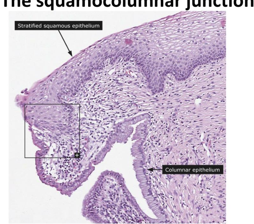 <p>The region of the cervix where the epithelium of the endocervix meets the epithelium of the ectocervix is called the squamo-columnar junction (SCJ). The position of the SCJ is fixed during development. </p>