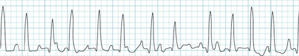 <p>Identify the arrhythmia shown on the EKG strip</p>
