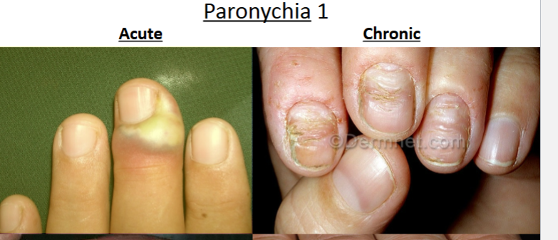 <p>paronychia acute vs. chronic forms*</p>