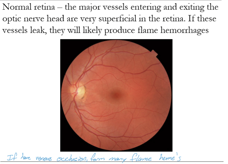 <p>Because blood spreads along the radial, feather‑like orientation of nerve fiber bundles in the NFL, producing the characteristic flame‑like shape.</p>