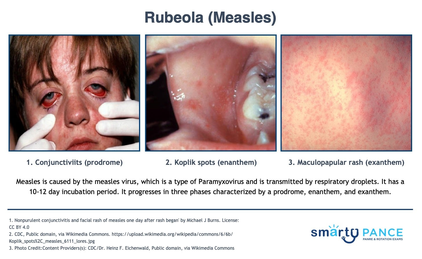 <p>Infection with the contagious, airborne measles morbillivirus </p><p>-Presentation: 3-5 days of high fever/cough/conjunctivitis/coryza, Koplik spots on the oral mucosa, then maculopapular rash that begins at the hairline and spreads down </p><p>-Dx: clinical, confirm with serum measles IgM or PCR, notify public health </p><p>-Tx: Vitamin A for hospitalized children < 2 years old, post-exposure prophylaxis with MMR within 72 hours </p>