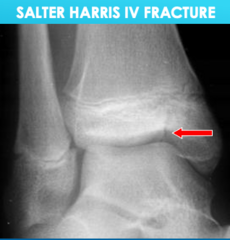 <p>Salter Harris IV Fracture</p>