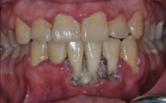 <p>1. Halitosis</p><p>2. Pain</p><p>3. Fever (may need antibiotics)</p><p>4. A grey pseudomembrane covering ulcers</p>