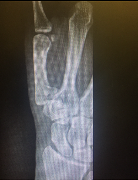 <ul><li><p>Fracture/dislocation of the metacarpal bone at the base of the thumb </p></li></ul><p></p>