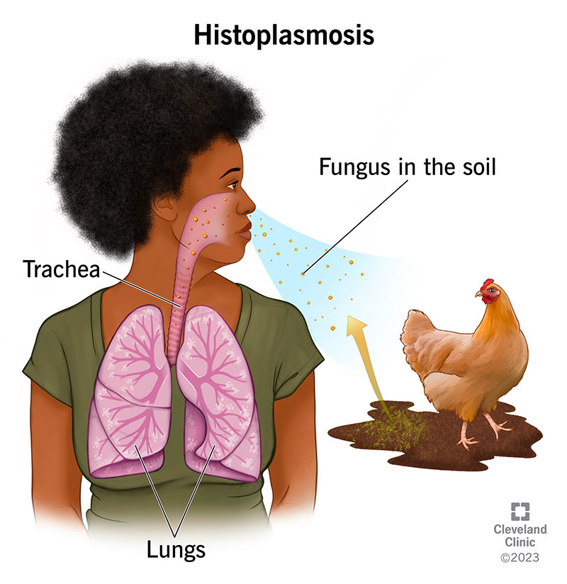 <p>a fungus (specifically, a mold) that causes histoplasmosis, a fungal infection of the lungs caused by inhalation of the spores </p>