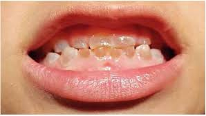 <p>dentina anómala por fallo en odontoblastos</p>