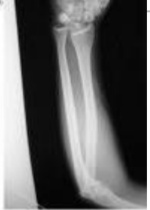 <p>Mecanismo de accion de esta fractura </p>