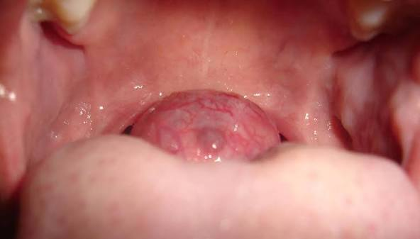 <ul><li><p>Developmental </p></li><li><p>Behind the circumvallate papilla </p></li><li><p>Sessile</p></li><li><p>2-3cm</p></li><li><p>Thyroid tissue </p></li></ul><p></p>