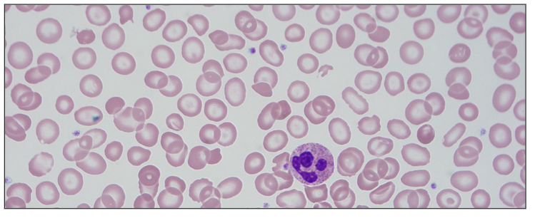 <p>Thalassaemia</p>