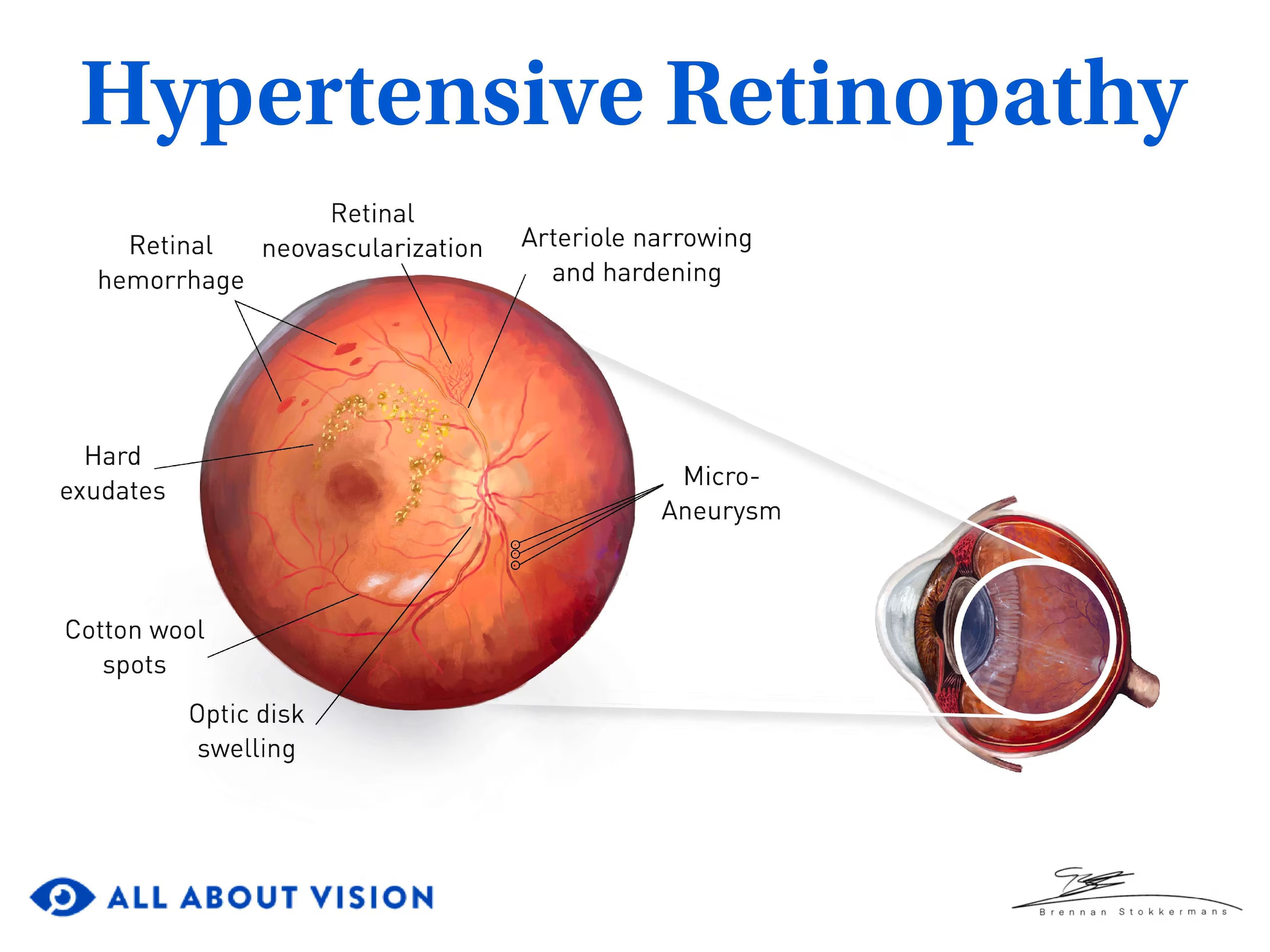 <p>CM: asx<br>or<br>decreased vision<br>artery narrowing</p><p>severe:<br>hard exudates<br>flame-shaped hemorrhages<br>optic nerve edema</p><p>TX: control BP</p>