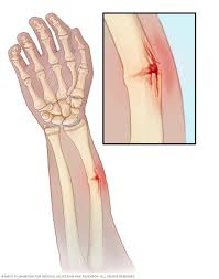 <p>greenstick fracture </p>