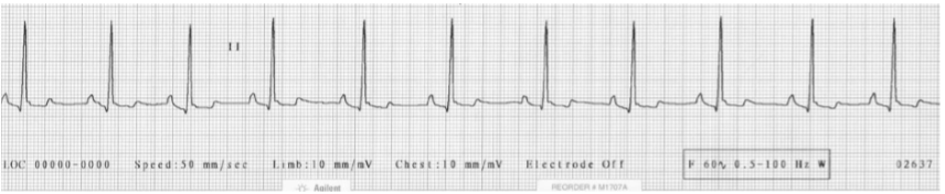 <p>This ECG is an example of a ________________</p><p>(give the definition and features)</p>