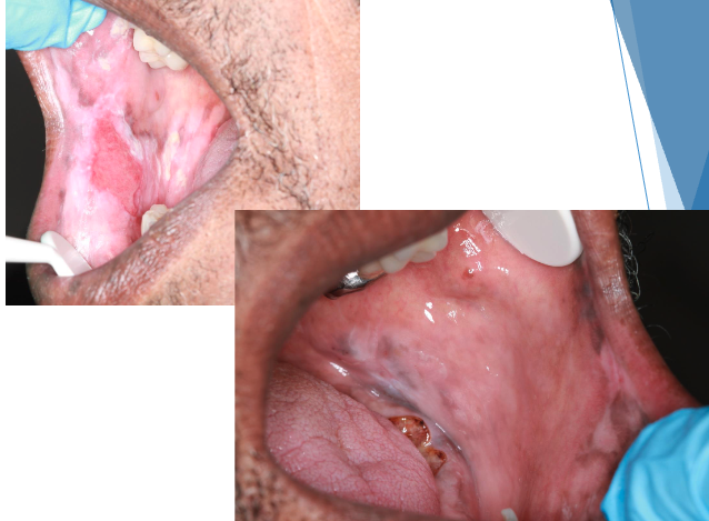 <p>what condition?</p><p>• Scaly red patches on sun-exposed skin</p><p>• Oral lesions identical to lichen planus</p><p>• Rarely without skin lesions</p>