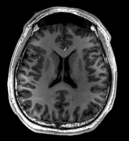 <p>-usually good resolution</p><p>-anatomy is obvious</p><p>-good contrast between soft tissue types</p><p>-low signal in cortical bone (like skull)</p><p>-usually gray scale</p>
