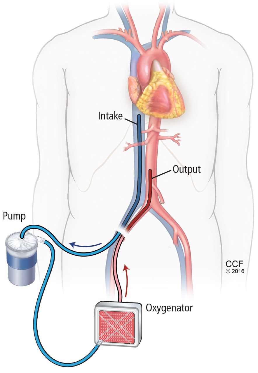<p>A high-speed pump assisting the left ventricle to eject blood into the aorta, unloading the LV, decreasing LV wall pressure and myocardial oxygen demand, while increasing MAP, cardiac output, and organ perfusion.</p>