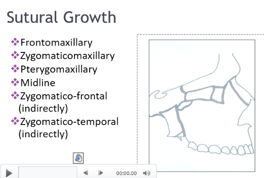 <ul><li><p>Frontomaxillary</p></li><li><p>zygomaticomaxillary</p></li><li><p>Pterygomaxillary</p></li><li><p>Midline</p></li><li><p>Zygomatico-frontal</p></li><li><p>Zygomatico-temporal </p></li></ul><p></p>