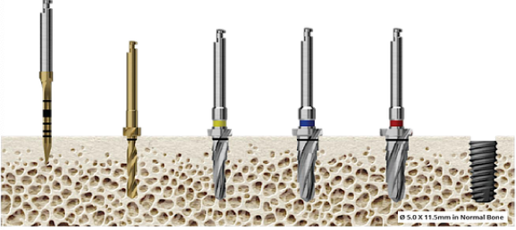 <p><span style="color: rgb(255, 0, 0);">Preparing the Osteotomy</span></p>