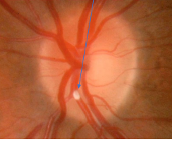 <ul><li><p>Typically from cholesterol embolus</p><ul><li><p>→ Ischemia → Thickening + whitening of the retina → Necrosis</p></li></ul></li></ul><p></p>