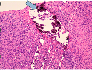 <p>2 types of mechanism</p><ul><li><p><span style="font-family: "Gill Sans MT";">Mechanism of </span><span style="font-family: "Gill Sans MT"; color: red;"><u>metastatic calcification</u></span><span style="font-family: "Gill Sans MT";">: patients who have <u>hypercalcemia </u>have deposition of calcium within </span>normal <span style="font-family: "Gill Sans MT";">or abnormal tissue</span></p></li><li><p><span style="font-family: "Gill Sans MT";">Mechanism of </span><span style="font-family: "Gill Sans MT"; color: red;"><u>dystrophic calcification</u></span><span style="font-family: "Gill Sans MT";">: patients who have normal levels of calcium have deposition of calcium only within abnormal tissue (necrosis or damage)</span></p></li><li><p><span style="font-family: "Gill Sans MT";">Organs affected: vasculature, kidneys, lungs</span></p></li><li><p><span style="font-family: "Gill Sans MT";">Gross morphology: hard, yellow nodules</span></p></li><li><p><span style="font-family: "Gill Sans MT";">Microscopic morphology: chunky, smooth, purple granules</span></p></li></ul><p></p>