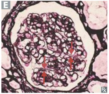 <p>A “tram-track” appearance is associated with which nephritic/nephrotic condition?</p>
