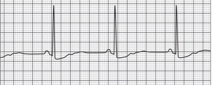 <p>QRS complexes present</p><ul><li><p>R to R is much bigger than normal pace</p></li></ul><p></p>